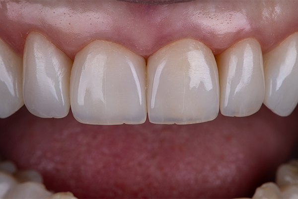 8, 9, 10 e 11 | Resultado após acabamento e polimento.