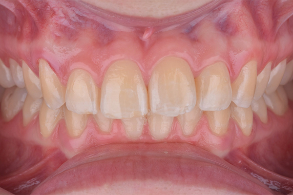 2 | Aspecto inicial, intraoral.