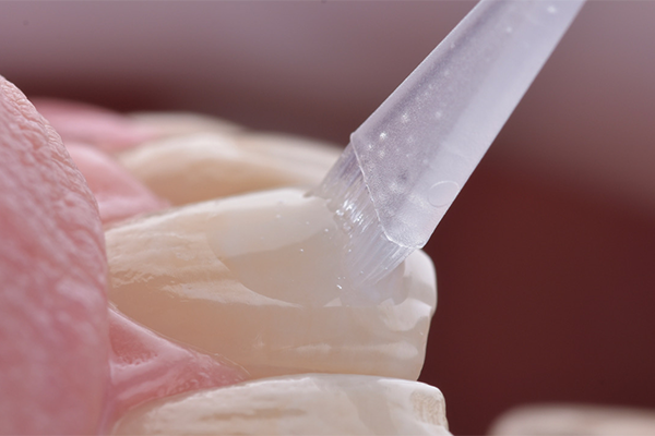 5A, 5B e 5C | Aplicação do gel clareador Whiteness HP AutoMixx 6%.