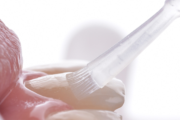 5A, 5B e 5C | Aplicação do gel clareador Whiteness HP AutoMixx 6%.