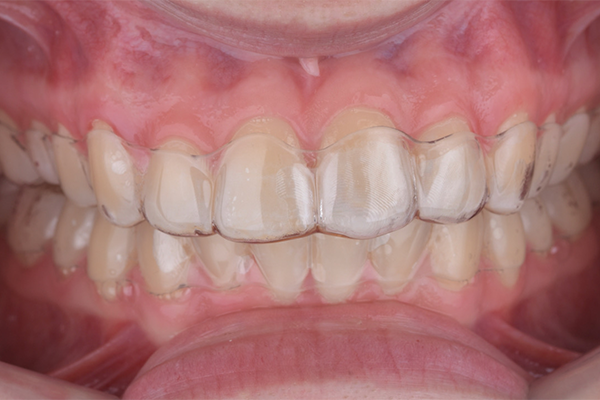 6 | Utilização das contenções como placas personalizadas de clareamento.