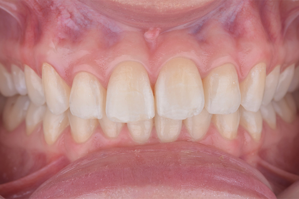 7 | Aspecto final, intraoral.