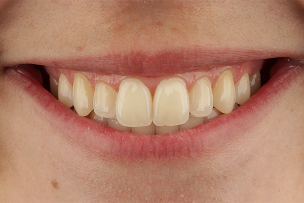 Caso Materia3 1 - Clareamento dental pela técnica caseira: praticidade, segurança e eficácia comprovadas 1 | Aspecto inicial do sorriso.