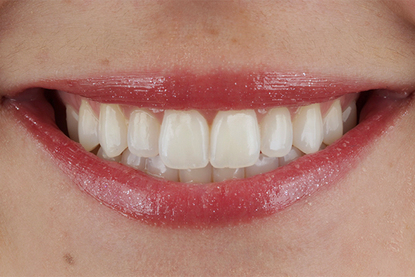 Caso Materia3 11 - Clareamento dental pela técnica caseira: praticidade, segurança e eficácia comprovadas 11 | Aspecto final do sorriso após o tratamento