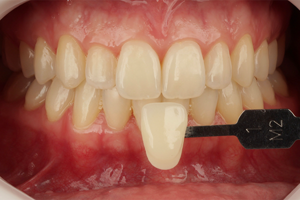 Caso Materia3 2 - Clareamento dental pela técnica caseira: praticidade, segurança e eficácia comprovadas 2 | Registro da cor inicial dos incisivos centrais utilizando escala de cor VITA Bleachedguide 3D-MASTER (1M2).