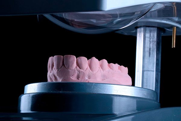 Caso Materia3 4 - Clareamento dental pela técnica caseira: praticidade, segurança e eficácia comprovadas 4 | Modelo superior em posicionamento para moldagem a vácuo em plastificadora.