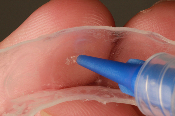 Caso Materia3 5 - Clareamento dental pela técnica caseira: praticidade, segurança e eficácia comprovadas 5 | Demonstração da aplicação de uma pequena gota de gel de peróxido de carbamida 10% Whiteness Perfect, nas faces vestibulares das moldeiras dos dentes a serem clareados. clareamento dental