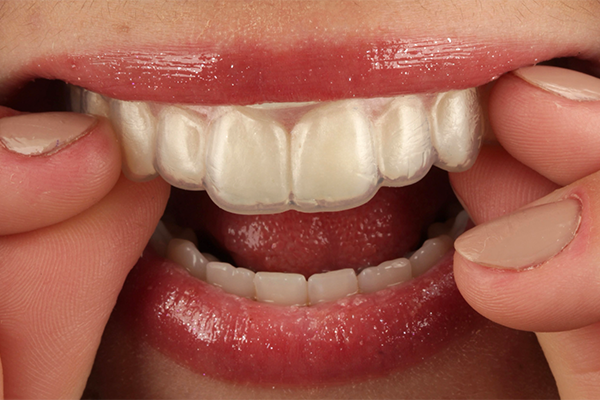 Caso Materia3 6 - Clareamento dental pela técnica caseira: praticidade, segurança e eficácia comprovadas 6 | Prova das moldeiras.