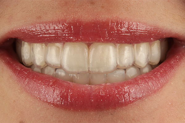 Caso Materia3 7 - Clareamento dental pela técnica caseira: praticidade, segurança e eficácia comprovadas 7 | Prova das moldeiras.