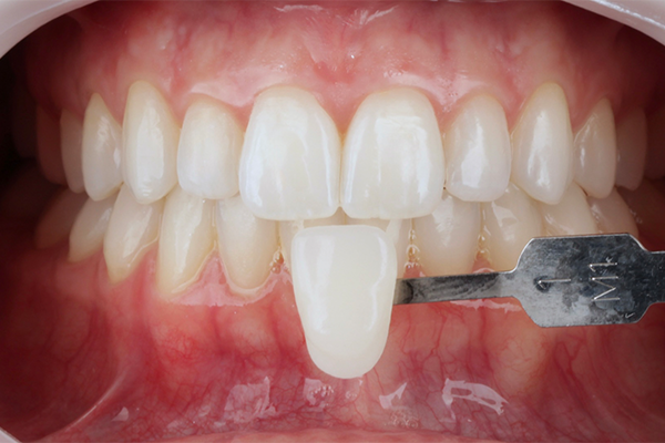 Caso Materia3 8 - Clareamento dental pela técnica caseira: praticidade, segurança e eficácia comprovadas 8 | Registro frontal da cor após duas semanas de tratamento do clareador utilizando escala VITA Bleachedguide 3D-MASTER (1M1).