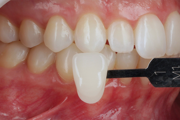 Caso Materia3 9 - Clareamento dental pela técnica caseira: praticidade, segurança e eficácia comprovadas 9 | Registro lateral direito da cor da cor após duas semanas de tratamento clareador utilizando escala VITA Bleachedguide 3D-MASTER (1M1).