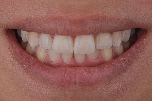 1 | Aspecto inicial do sorriso.