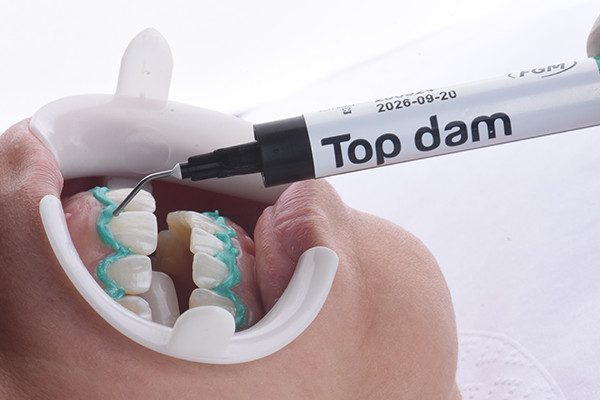 2 e 3 | Aplicação da barreira gengival Top Dam para proteção dos tecidos moles durante o clareamento em consultório.