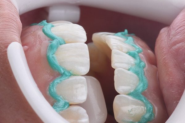 2 e 3 | Aplicação da barreira gengival Top Dam para proteção dos tecidos moles durante o clareamento em consultório.