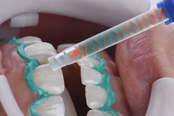 4 e 5 | Aplicação do agente clareador Whiteness HP AutoMixx 35% Plus. técnica associada