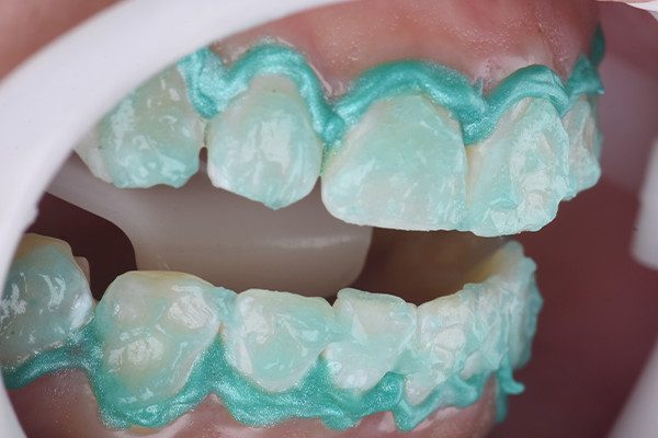 4 e 5 | Aplicação do agente clareador Whiteness HP AutoMixx 35% Plus.