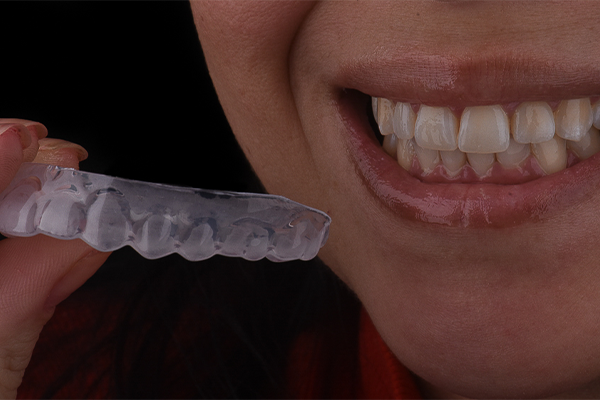 6 | Entrega da moldeira personalizada para continuidade do tratamento com o clareamento caseiro supervisionado.