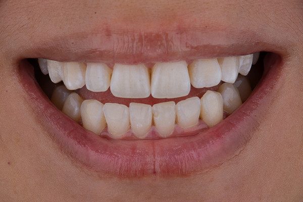 9 | Resultado do clareamento dental.