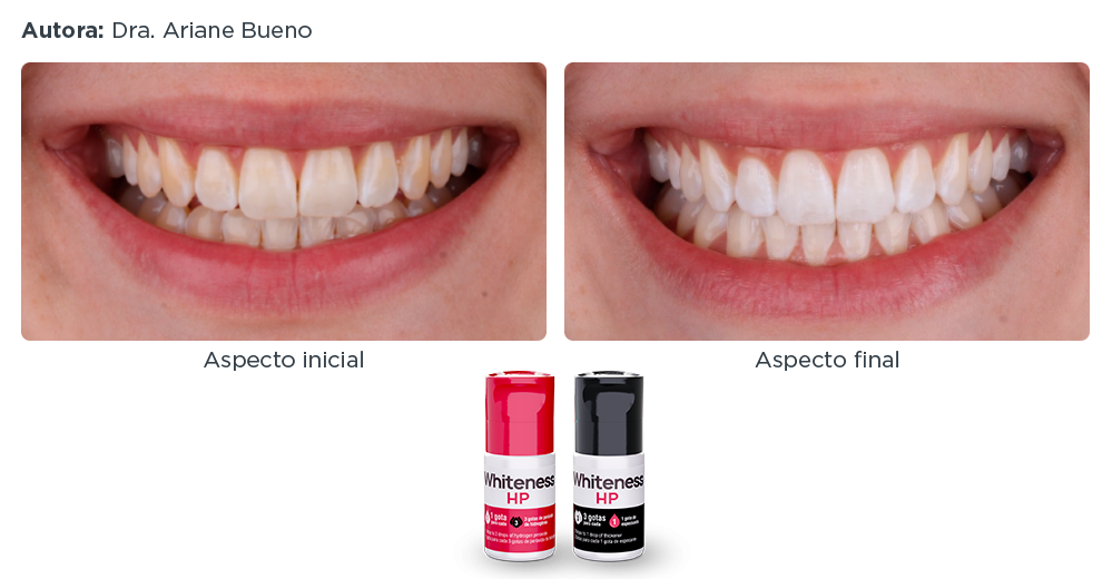 caso-clinico-lp-7-whiteness-hp