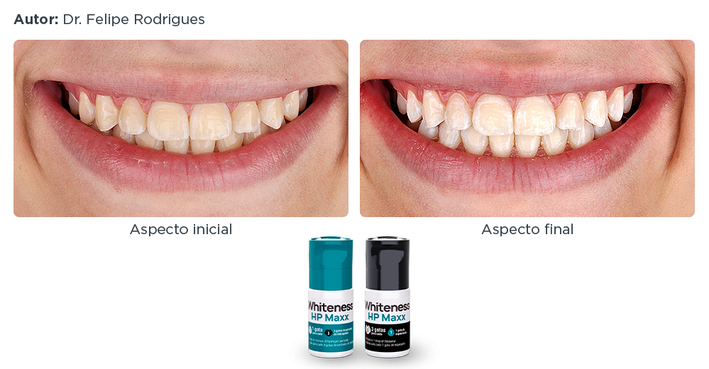 caso-clinico-lp-8-whiteness-hp-maxx