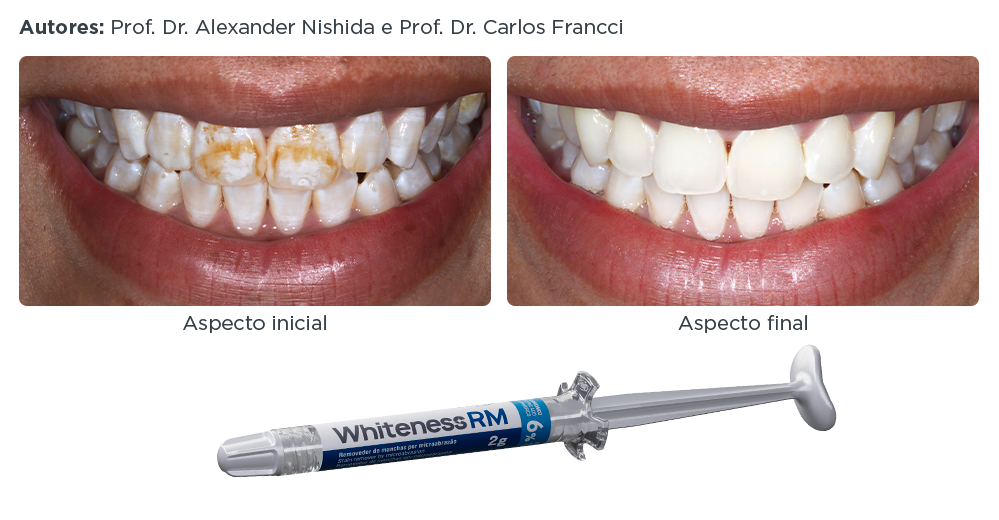 caso-clinico-lp-9-whiteness-rm