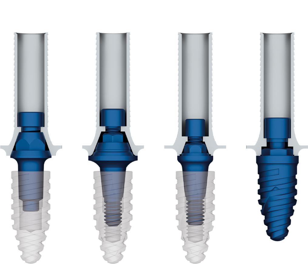 elemento fiber implantes - Fiber Pro
