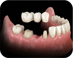 elemento full x protese parcial - Voxelprint FULL-X Tough