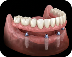 elemento full x protese total - Voxelprint FULL-X Tough