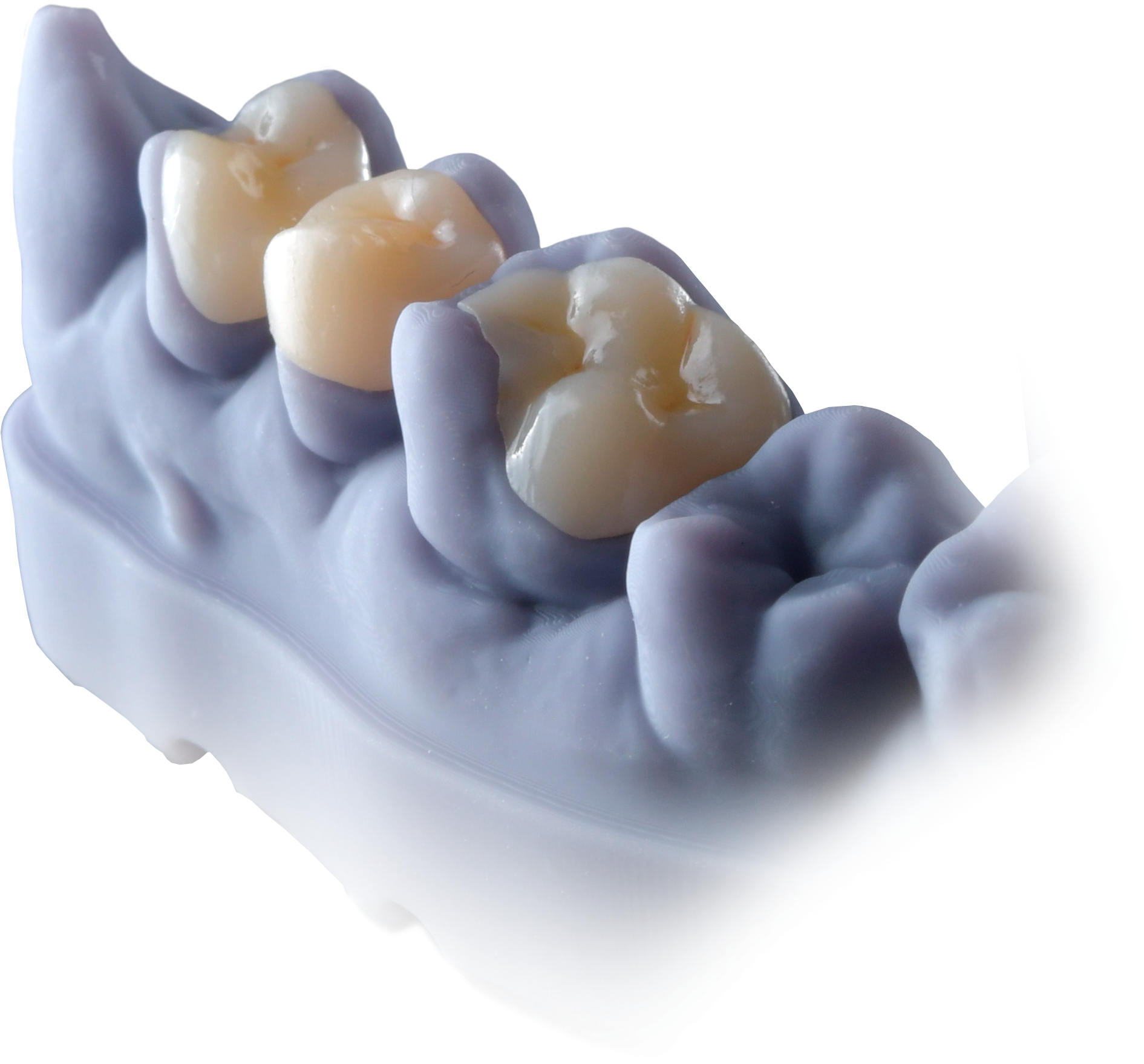 img protese voxel ceramic - Voxelprint