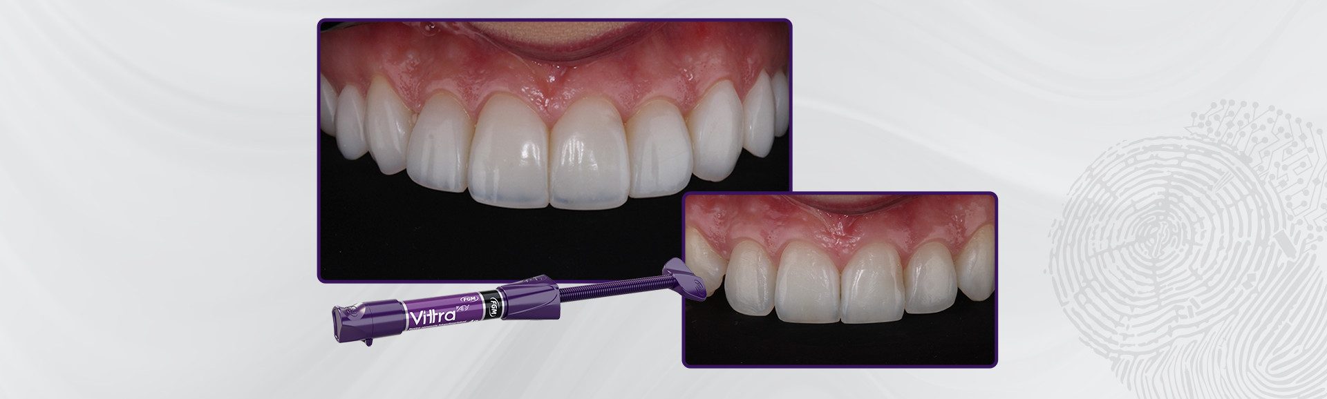 2026-Caso-5_Capa-Sorriso-com-naturalidade-facetas-biomiméticas-em-resina-composta-na-escala-bleach