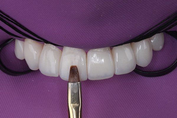 10 | Cobertura final vestibular feita em camada única de resina de esmalte Bleach, Vittra APS, na cor EBL3. Desta forma os efeitos incisais são suavizados com uma resina semitranslúcida, conferindo uma borda mais natural.