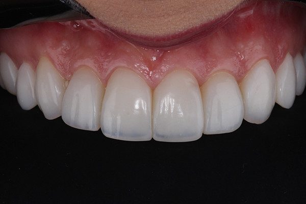 11A e 11B | Resultado após acabamento e remoção de excessos cervicais, texturização e polimento final.