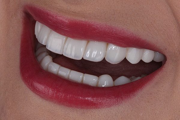 13| Resultado final. facetas bleach