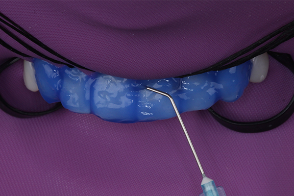 3 | Aplicação de ácido fosfórico 37% Condac 37 por 30s em todas as superfícies de esmalte, inclusive nas regiões interproximais que são facilmente acessadas com a microponta aplicadora.