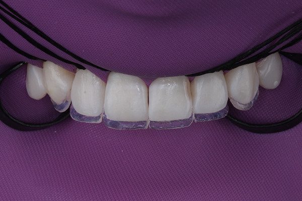 5 | Estratificação da camada palatina à mão livre, com resina composta de alto nível de translucidez, Vittra APS, na cor Trans N.