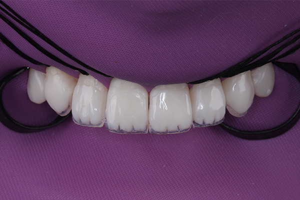 7 | Camada de dentina com resina bleach, Vittra APS, na cor DBL3. Aplicação feita na vestibular, com atenção especial aos efeitos de mamelos dentinários.