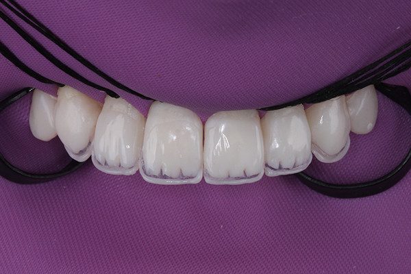 8 | Fino rolete na incisal dos elementos para reproduzir o halo opaco com a resina Vittra APS na cor DBL3.