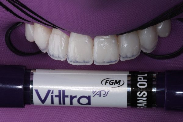 9 | Espaço entre os mamelos e o halo opaco preenchido com resina de efeito opalescente, Vittra APS, na cor Trans OPL.