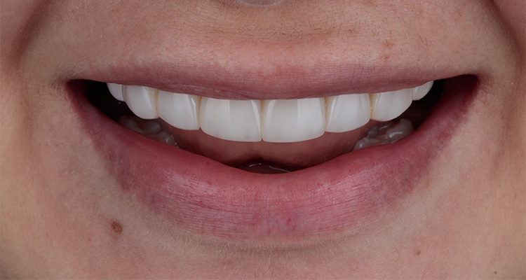 Caso 17 1 - Substituição de facetas em resina composta associada à otimização do substrato por meio de clareamento dental 1 | Sorriso frontal inicial.