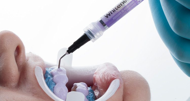 Caso 17 10 - Substituição de facetas em resina composta associada à otimização do substrato por meio de clareamento dental 10 | Aplicação do gel clareador Whiteness HP Blue 35%