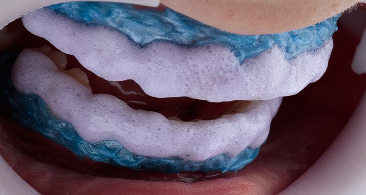 Caso 17 11 - Substituição de facetas em resina composta associada à otimização do substrato por meio de clareamento dental 11 | Gel clareador Whiteness HP Blue 35%.