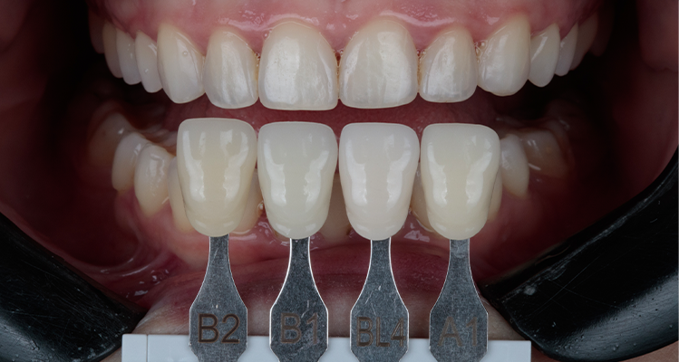Caso 17 12 - Substituição de facetas em resina composta associada à otimização do substrato por meio de clareamento dental 12 | Registro da cor após clareamento.
