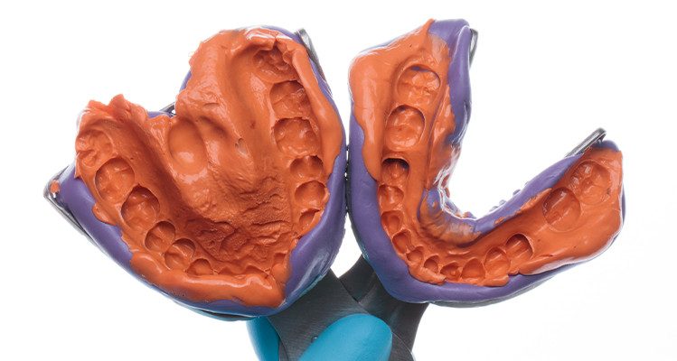 Caso 17 13 - Substituição de facetas em resina composta associada à otimização do substrato por meio de clareamento dental 13 | Moldes dos arcos superior e inferior com silicone de adição Silic-One