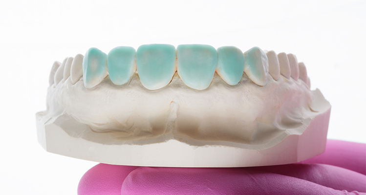 Caso 17 14 - Substituição de facetas em resina composta associada à otimização do substrato por meio de clareamento dental 14 | Enceramento diagnóstico.