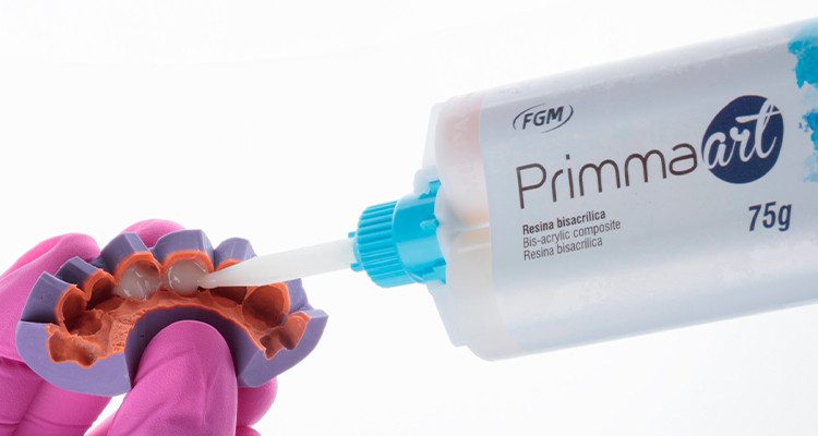 Caso 17 15 - Substituição de facetas em resina composta associada à otimização do substrato por meio de clareamento dental 15 | Aplicação da resina bisacrílica PrimmaArt na muralha de silicone Silic-One pra realização de mockup