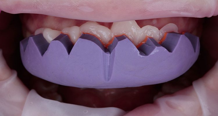 Caso 17 16 - Substituição de facetas em resina composta associada à otimização do substrato por meio de clareamento dental 16 | Inserção da muralha de silicone Silic-One com a resina bisacrílica PrimmaArt em boca.