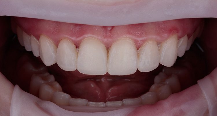 Caso 17 17 - Substituição de facetas em resina composta associada à otimização do substrato por meio de clareamento dental 17 | Foto intraoral frontal com mockup.