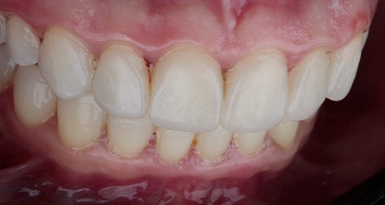 Caso 17 18 - Substituição de facetas em resina composta associada à otimização do substrato por meio de clareamento dental 18 | Foto intraoral lateral direita com mockup.