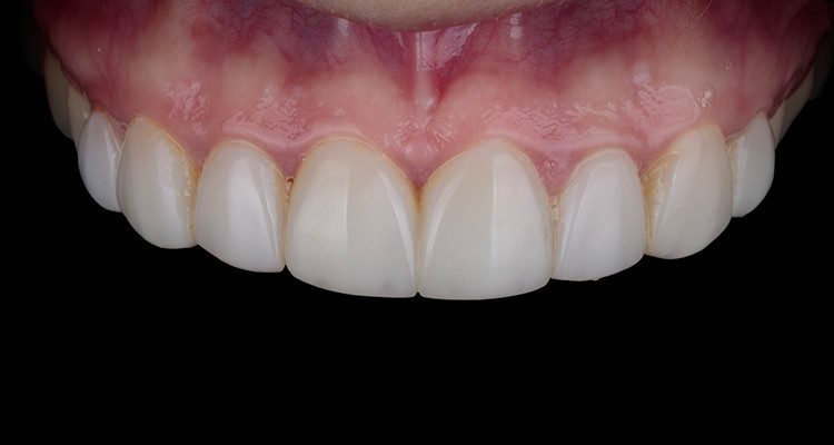 Caso 17 2 - Substituição de facetas em resina composta associada à otimização do substrato por meio de clareamento dental 2 | Foto intraoral frontal com fundo preto inicial.