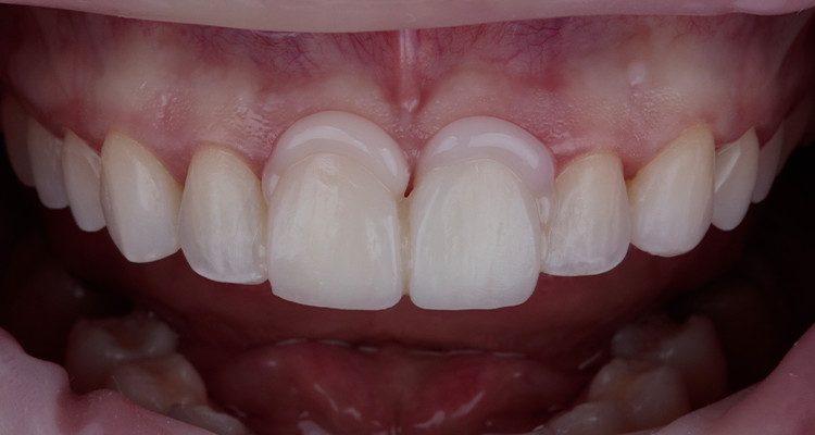 Caso 17 21 - Substituição de facetas em resina composta associada à otimização do substrato por meio de clareamento dental 21 | Prova das facetas em boca com pasta try-in Allcem Veneer Try-in, para verificação da cor.